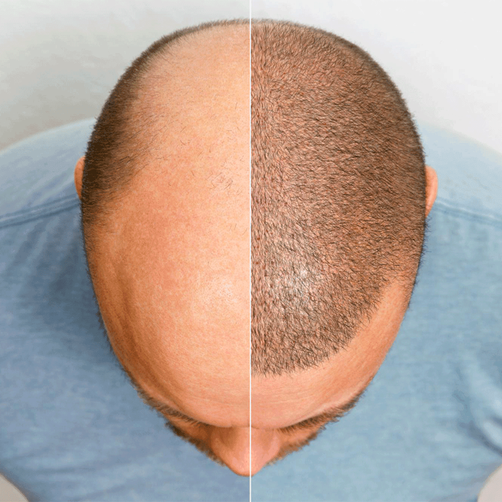 زراعة الشعر